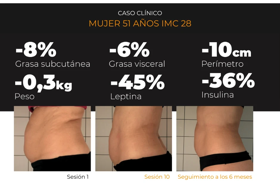 Caso clínico real Drakarian: mujer 51 años IMC 28 — −8% grasa subcutánea, −6% grasa visceral, −10 cm perímetro, −0,3 kg peso, −45% leptina, −36% insulina en sesión 10 y seguimiento 6 meses